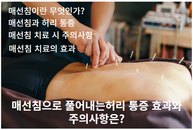 매선침