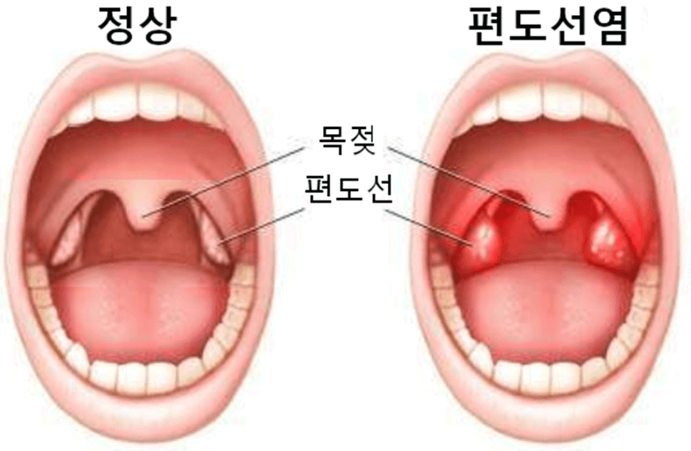 편도선염