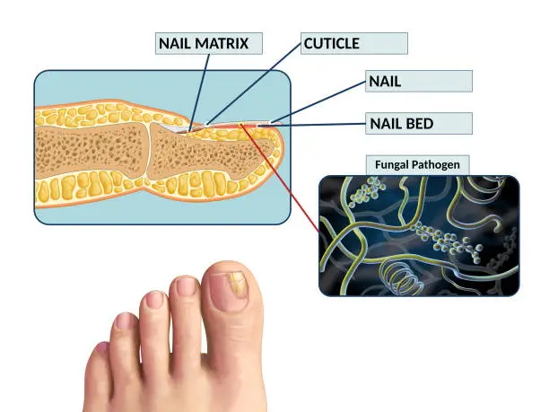 발톱무좀 없애는 방법