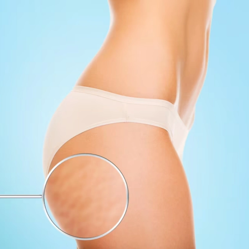 여성 허벅지에 있는 셀룰라이트 썸네일