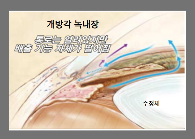 개방각 녹내장 증상