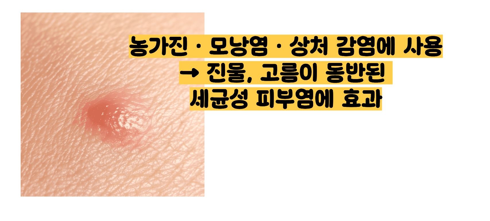 박테로신 연고 효능