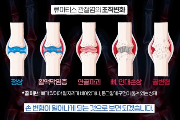 류마티스관절염-조직변화