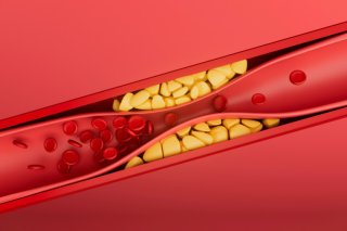 주요 원인과 고위험군