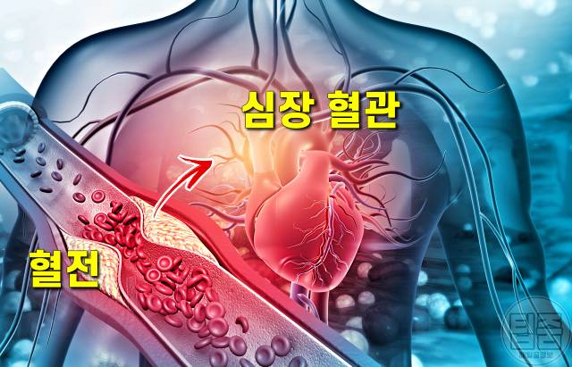 왼쪽 팔저림 심장마비 전조증상,팔이 저린 이유