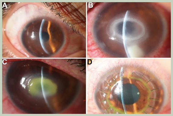 가시아메바 각막염 증상