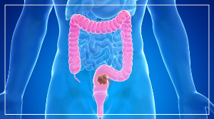 대장암초기증상 치료법