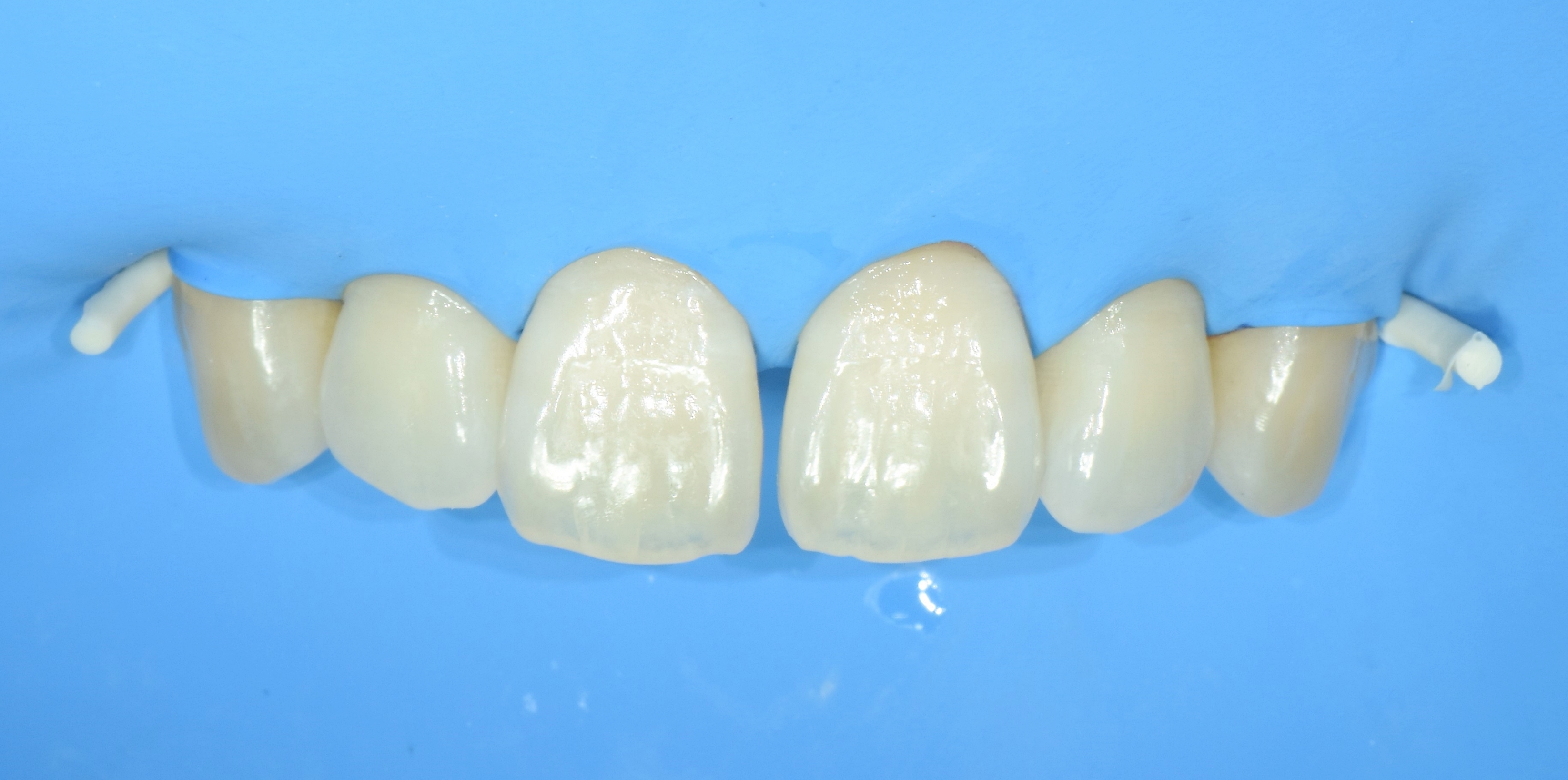 치아 삭제 없이 러버댐 방습 하에 진행되는 앞니 틈새 BRD 레진 접착 치료 과정