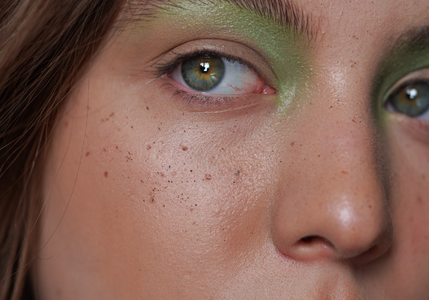 여드름 개선에 대한 콜린 이노시톨 효능