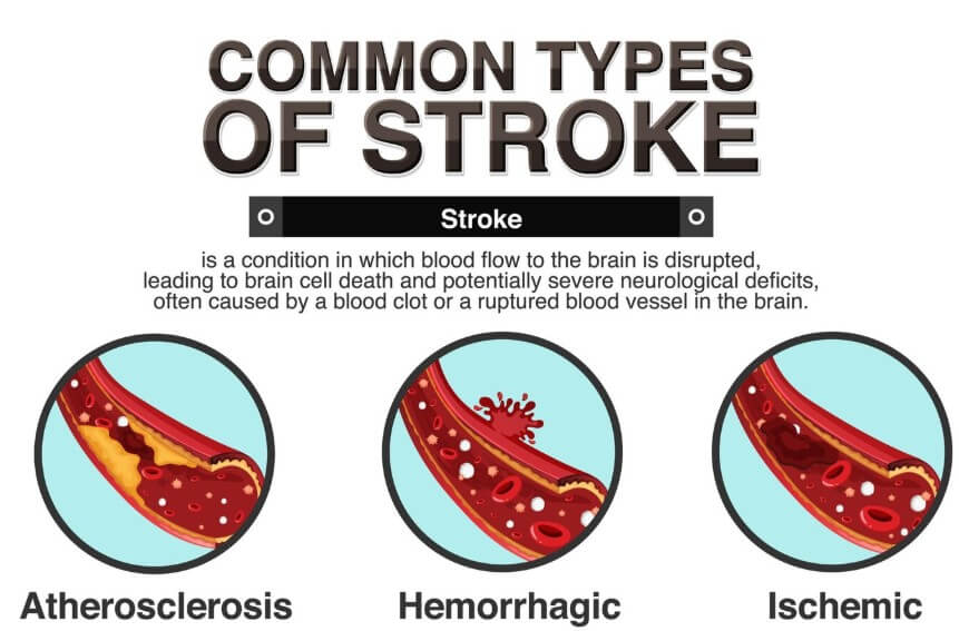 혈관 속 노폐물