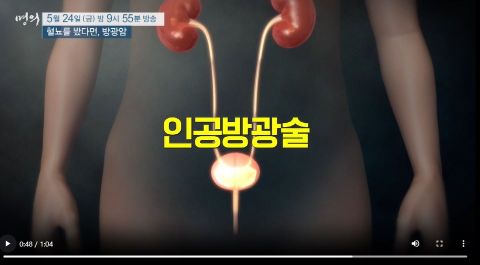 ebs 명의 방광암 다시보기 추천 증상