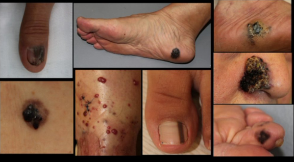 선천성거대모반-흑색종-원인-치료-명의-리스트