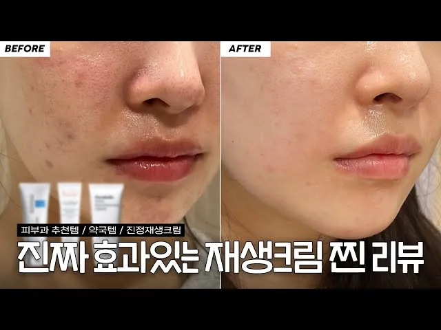 여드름 재생크림 클렌징폼 꿀템 10선_9