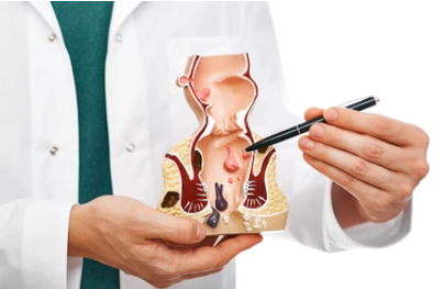 치질 자가치료법