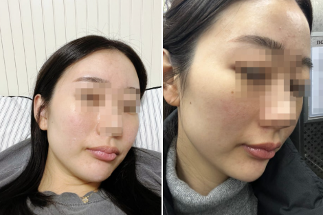 에보덤 판토힐 내돈내산 효과