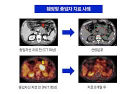 췌장암 중입자 치료 사례