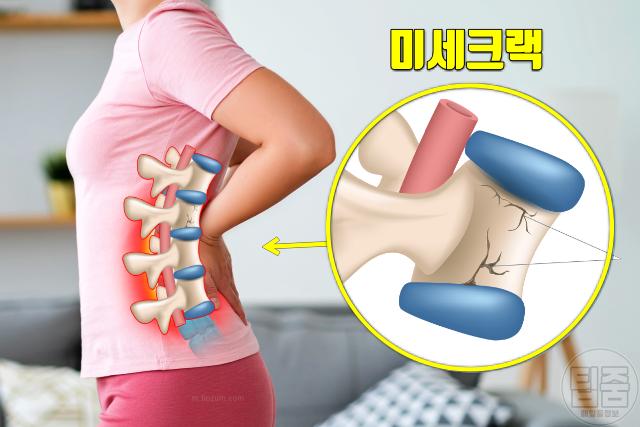 골다공증 증상 초기증상 허리통증