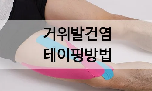 거위발 건염 원인과 증상 무릎 안쪽 통증 치료법 정리_7