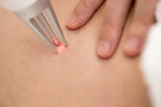 혈관 레이저 시술, 효과와 주의사항 정리