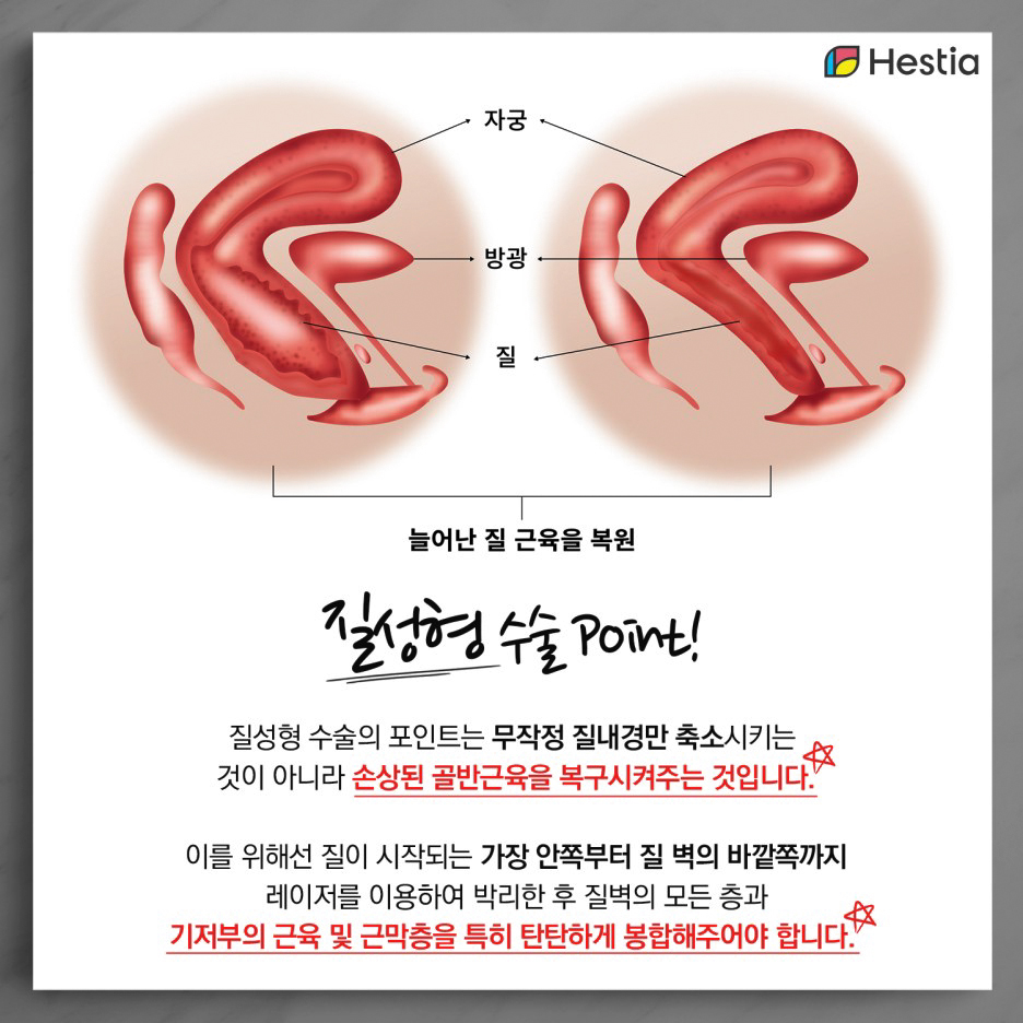 질성형수술 포인트
