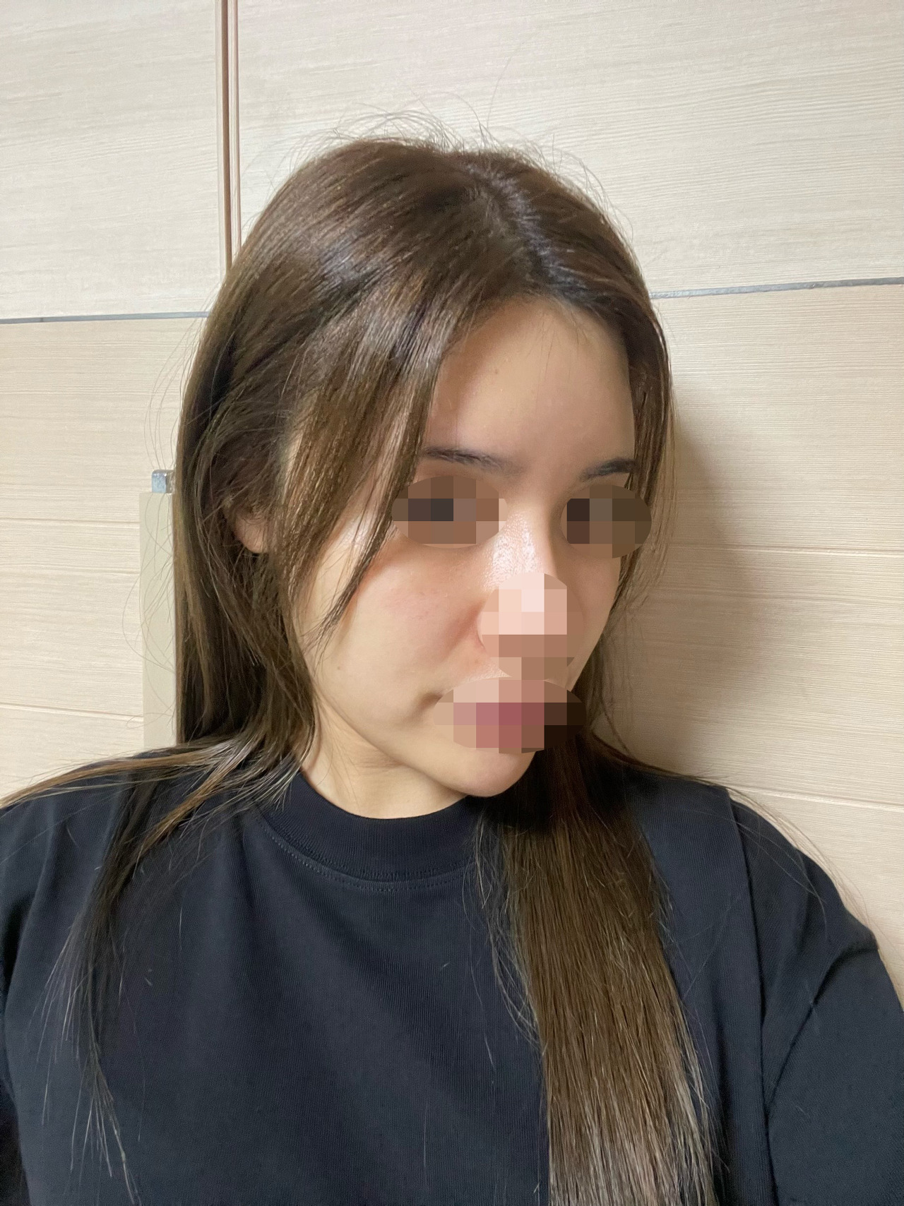 써마지 후기