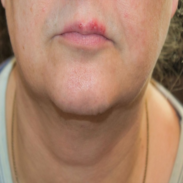 입술 물집 빨리 가라앉히는 방법 정리