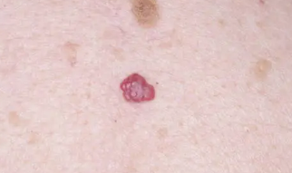 피부 붉은반점 37