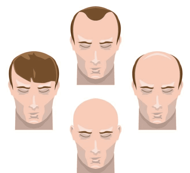 남성탈모 프로페시아