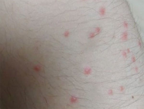 호텔-펜션-벌레물린자국