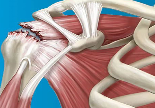 회전근개 어깨통증 세라밴드운동 어깨운동 오십견 어깨재활 근육강화 통증관리 자가치료 물리치료