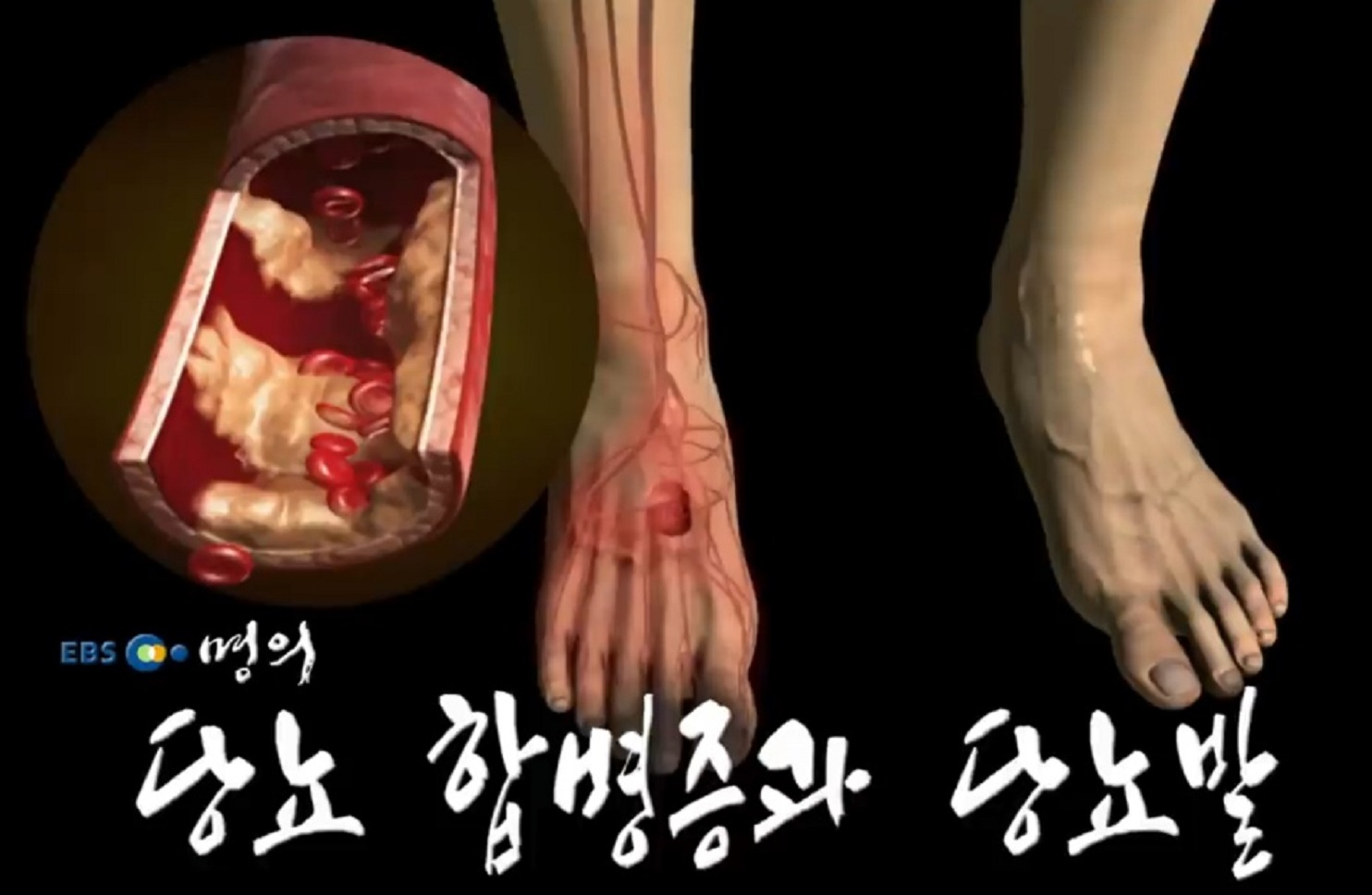 명의-당뇨발-천동일-교수-당뇨병