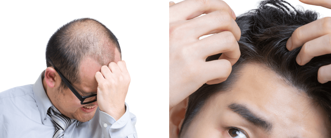 탈모로 고민하는 사진