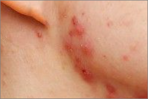 여드름 흉터 없애는법