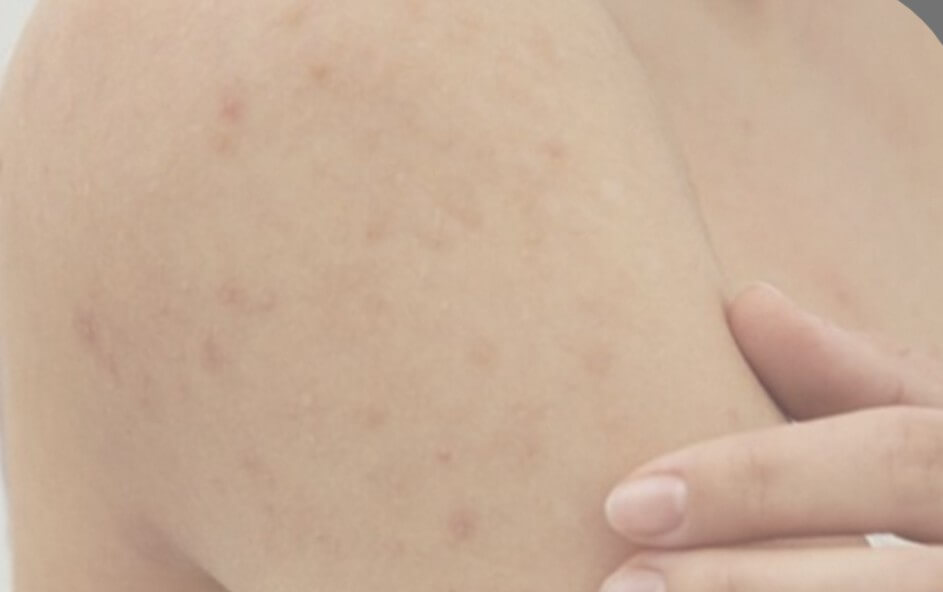 모공각화증 피부 증상