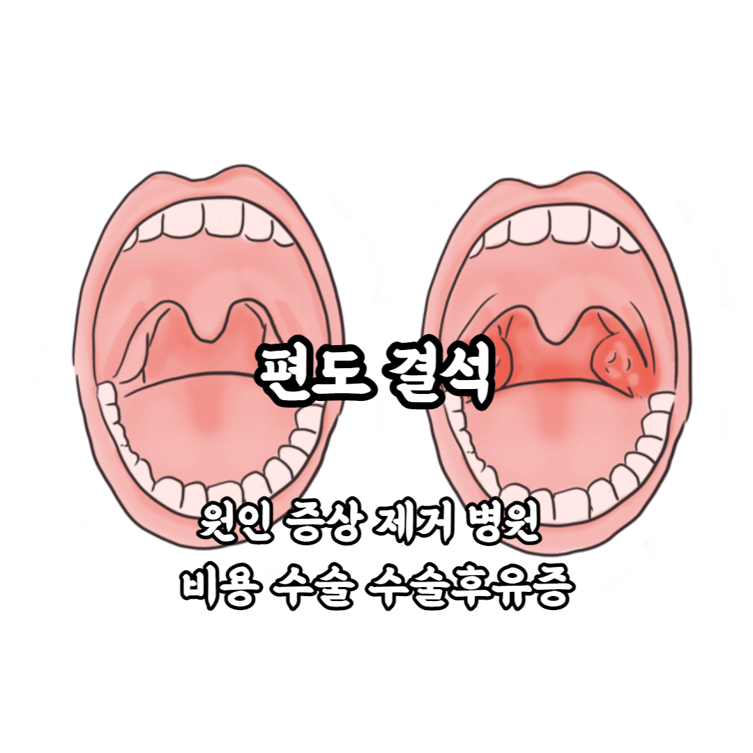 편도결석 편도 결석 증상 원인 제거 병원 비용 수술 수술 후유증
