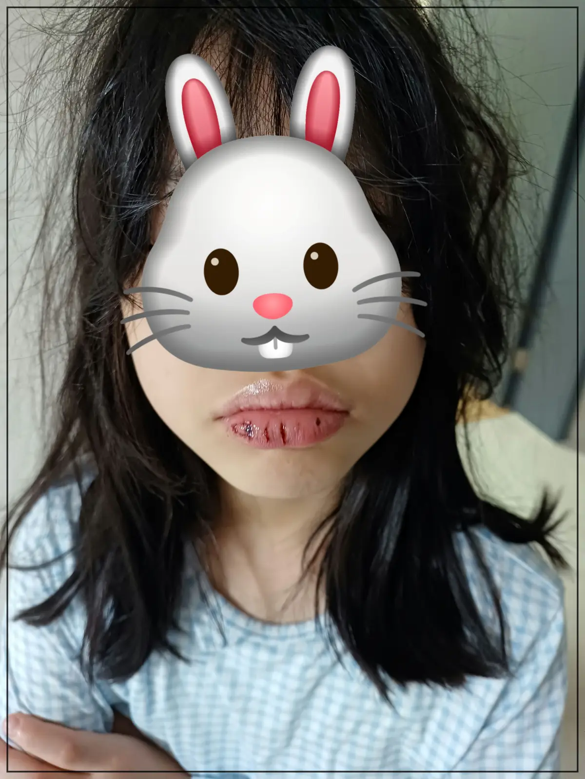 입술-부르튼-사진-입술-피