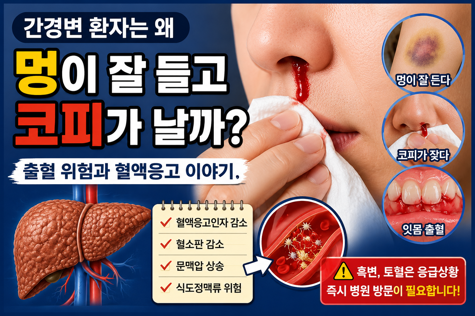 간경변 환자에서 혈액응고인자 감소와 혈소판 감소로 인해 멍이 잘 들고 코피가 나는 원인을 설명하는 의료 건강정보 썸네일 이미지