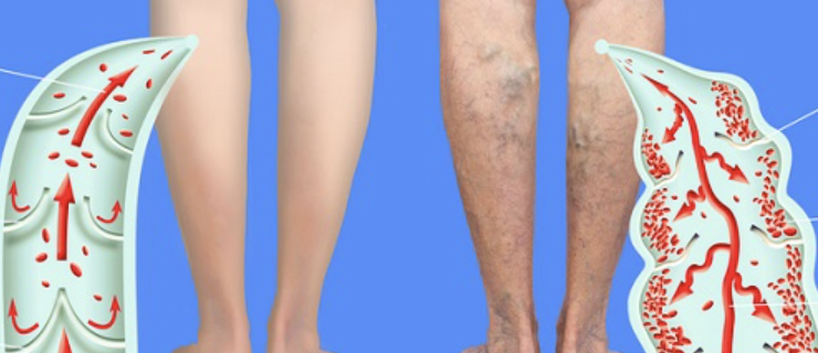 하지 정맥류 증상 2