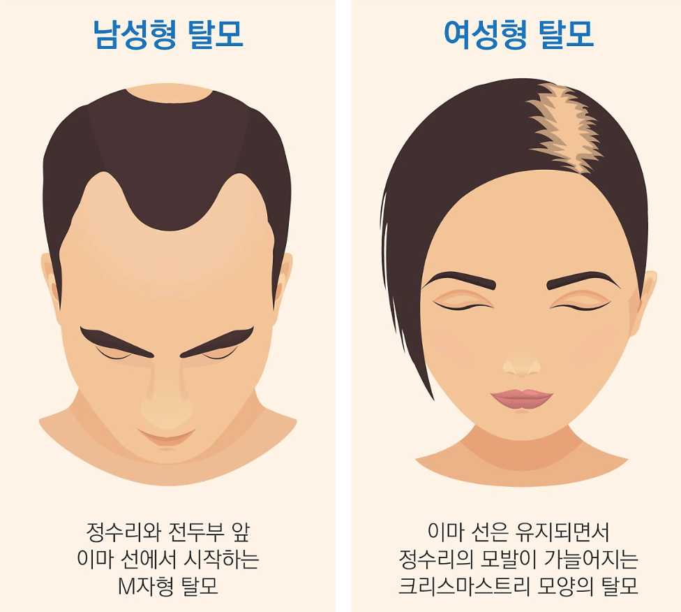 대표적인-탈모-이미지