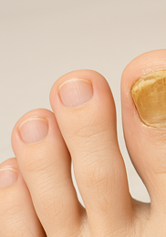 발톱무좀 없애는 방법