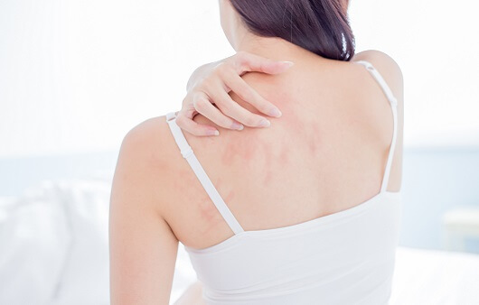 아토피성 피부염의 원인과 완화 치료 방법 알아보기