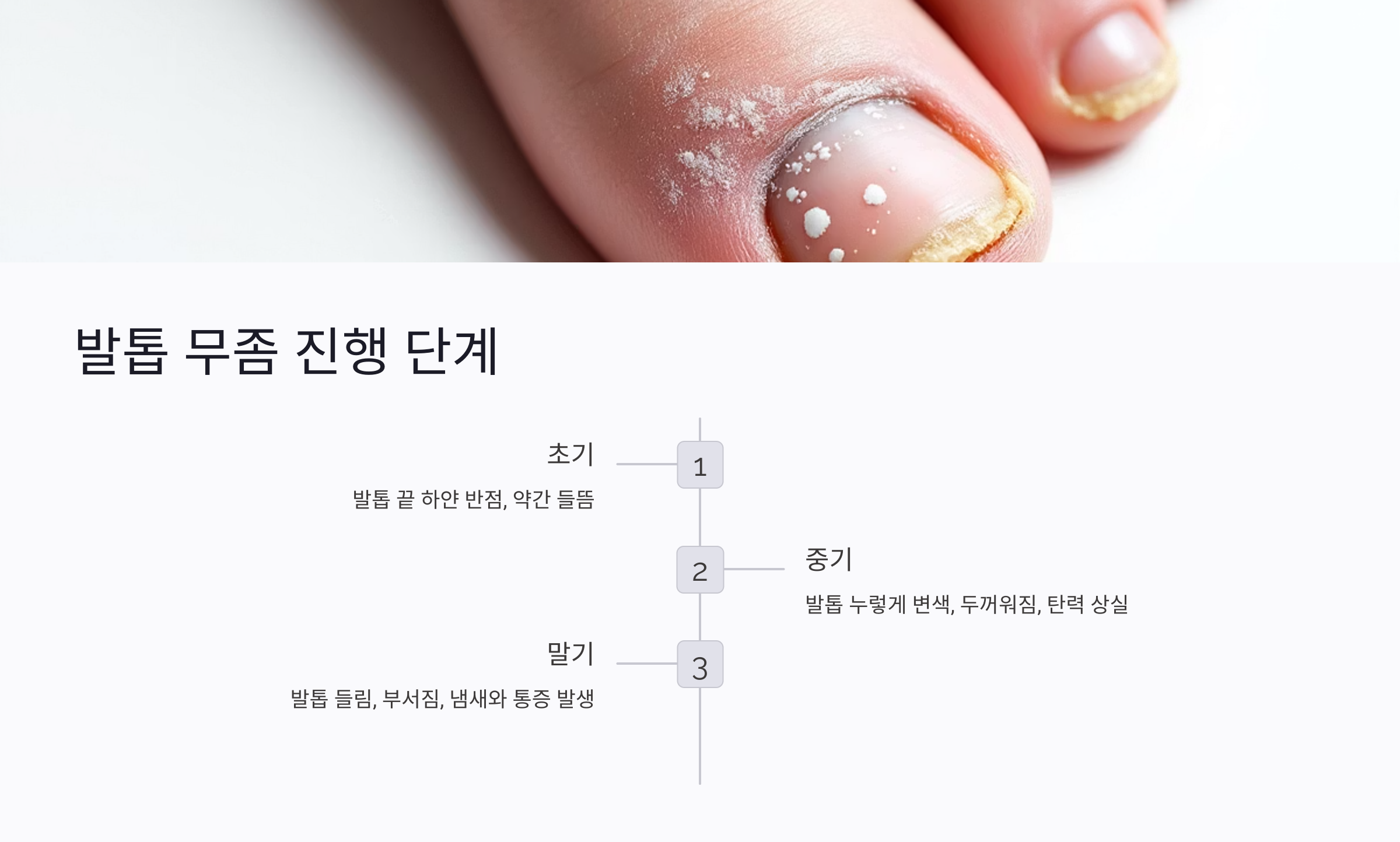 발톱 무좀 증상 단계별 변화
발톱 무좀은 크게 세 단계로 진행되며, 초기에 조치를 취하면 비교적 간단한