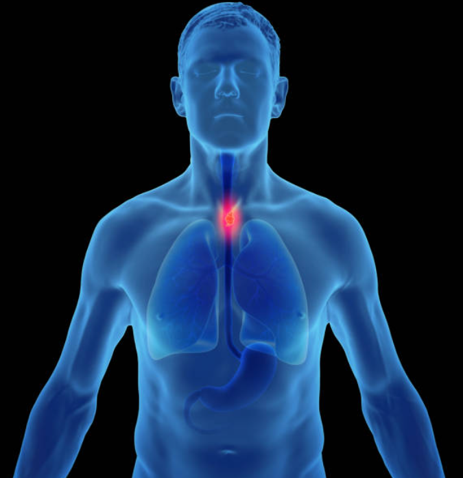 식도암 관련 사진2