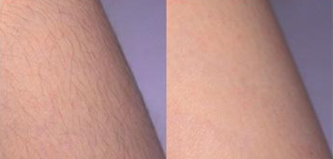 바디트리머(모근제거기)