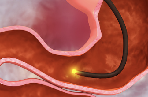 십이지장 궤양 증상 27