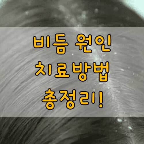 머리 감아도 비듬&#44; 머리 감아도 각질&#44; 머리 감았는데 비듬&#44; 비듬의 원인부터 치료방법 까지 총정리