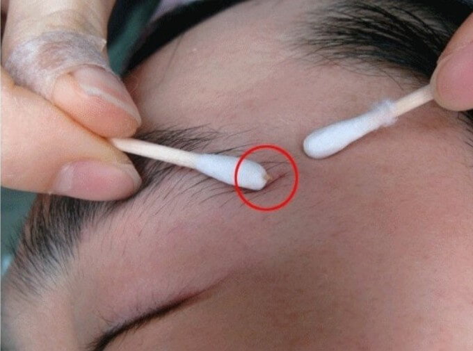 피지 자가 제거