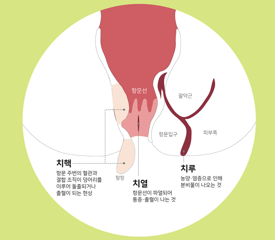 치질 증상 12가지 총정리 섬네일
