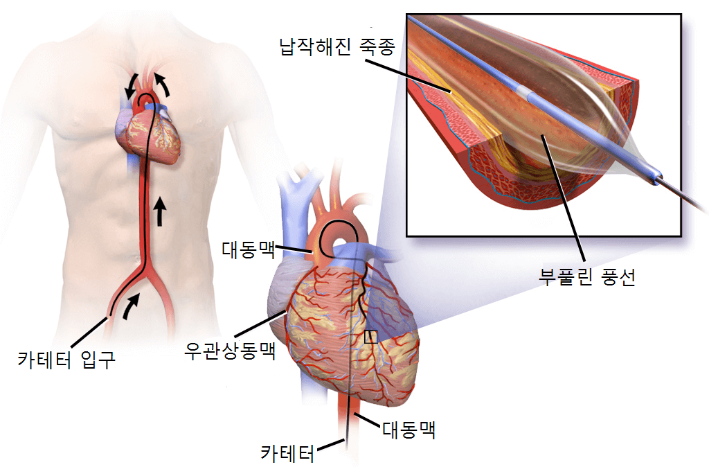 Percutaneous coronary intervention 경피적관상동맥중재술
