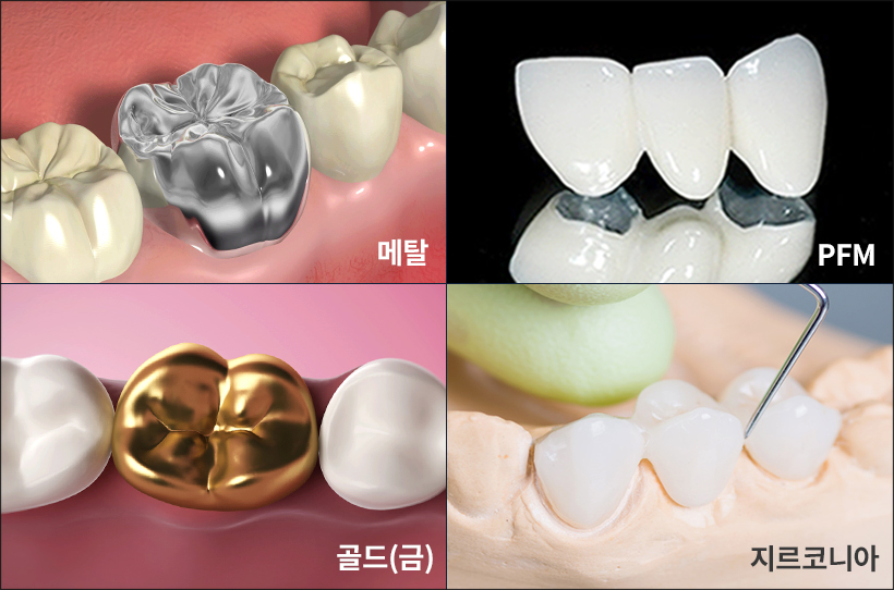임플란트 치료 시 선택할 수 있는 보철물의 재료 종류